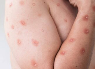 Oito Estados Entram Em Alerta Máximo Para Mpox No Brasil Oito Estados Entram Em Alerta Máximo Para Mpox No Brasil