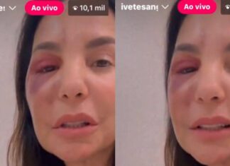 Em Live, Ivete Sangalo Detalha Cirurgia No Rosto Após Queda No Banheiro