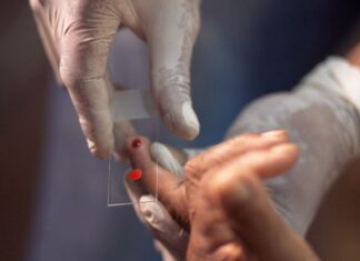 SUS começa a usar novo tratamento contra a malária em crianças