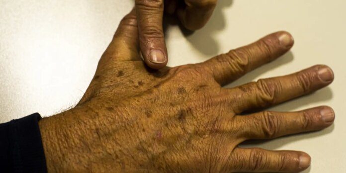 cancer_de_pele_melanoma20220520_0621.jpg